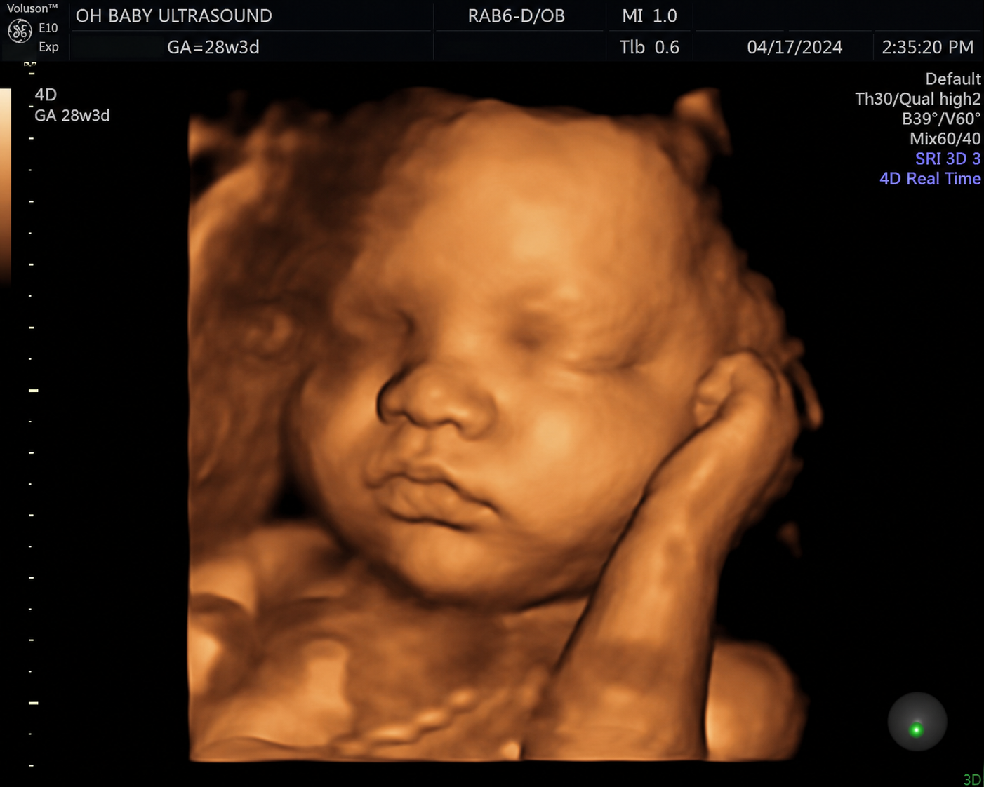 4D ultrasound face
