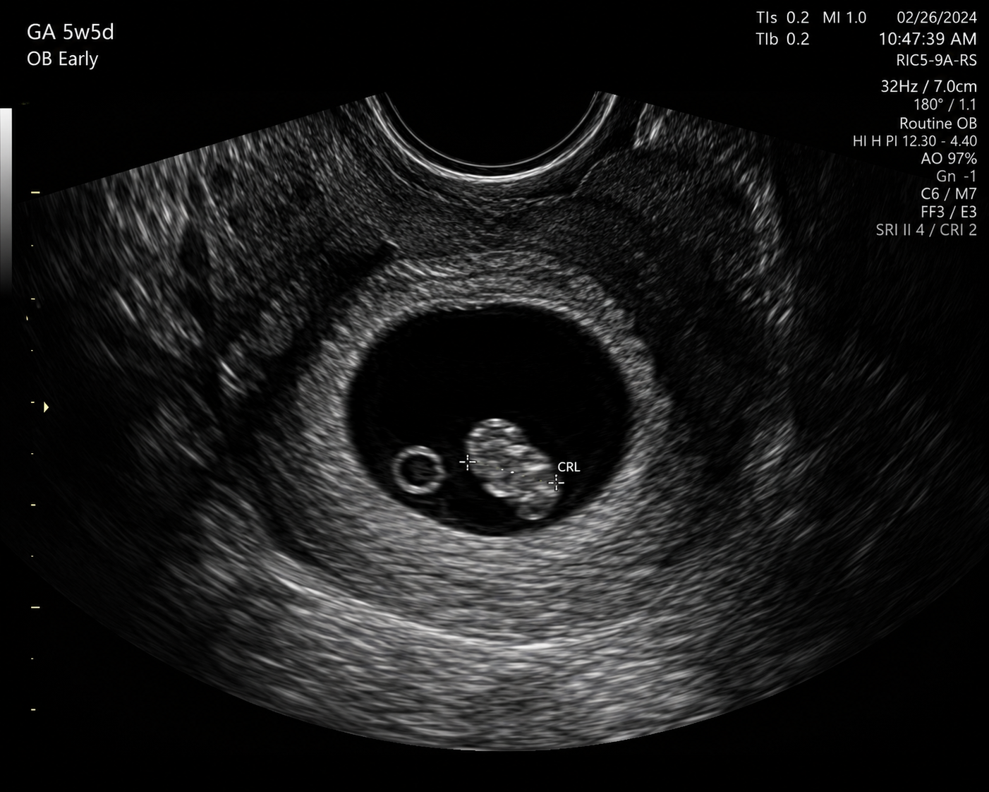 Early Scan — 5 Weeks
