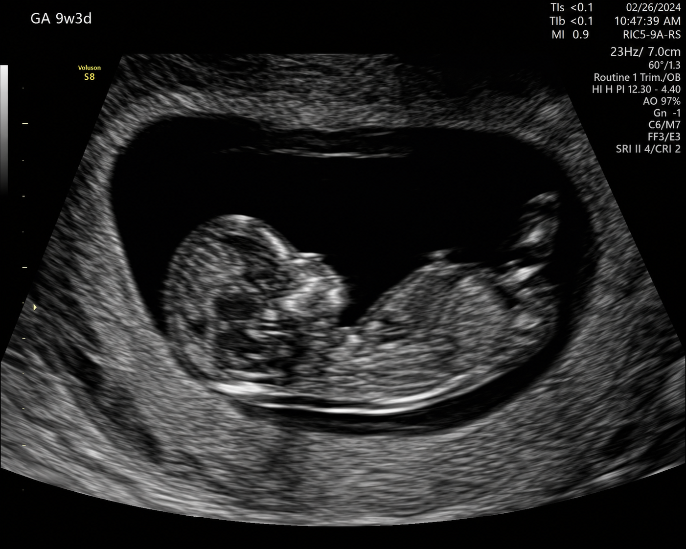 Early pregnancy 2D scan